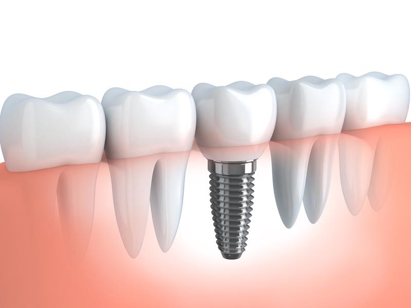 Dental Implants  Colorado Springs, CO 